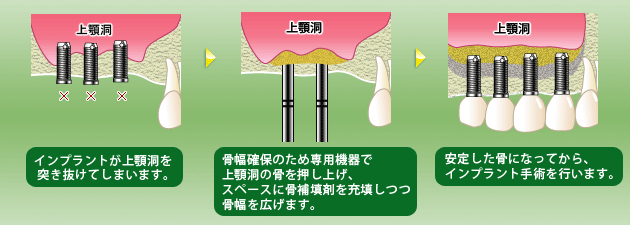 ソケットリフト